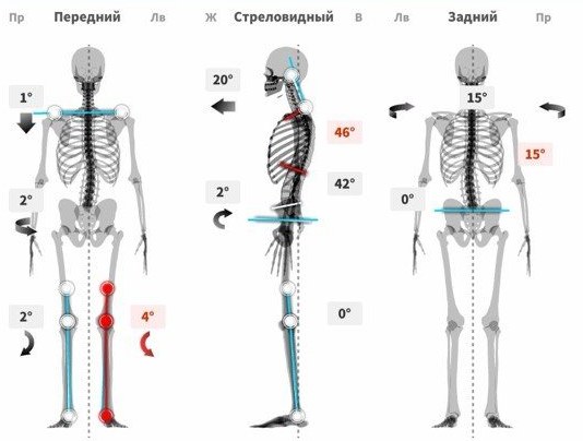 Пример результата 3D-сканирования: скелет в трёх проекциях — спереди, сбоку и сзади — с углами отклонений в градусах